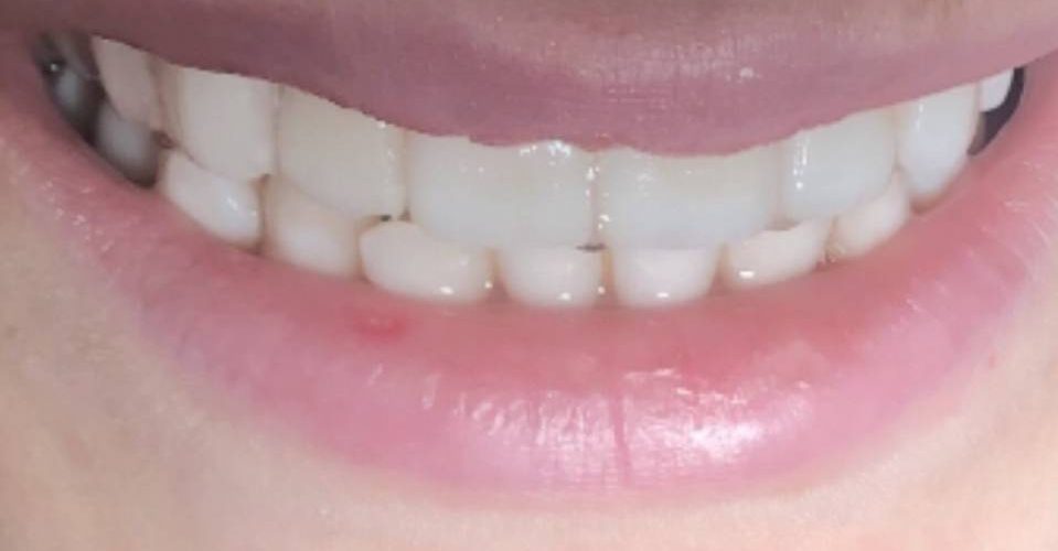 Teeth Straightening